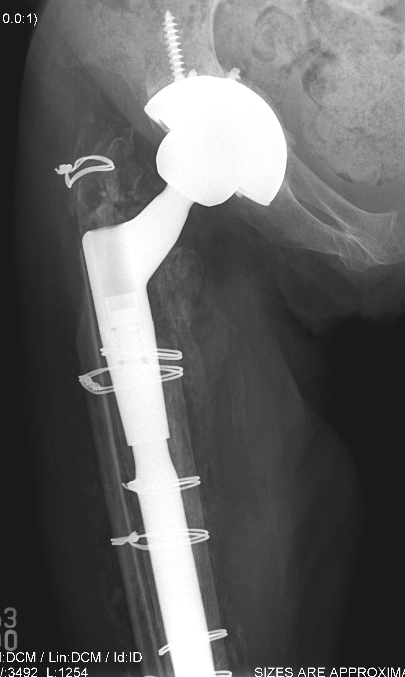 Revision PFF with Modular Uncemented and Strut Allograft